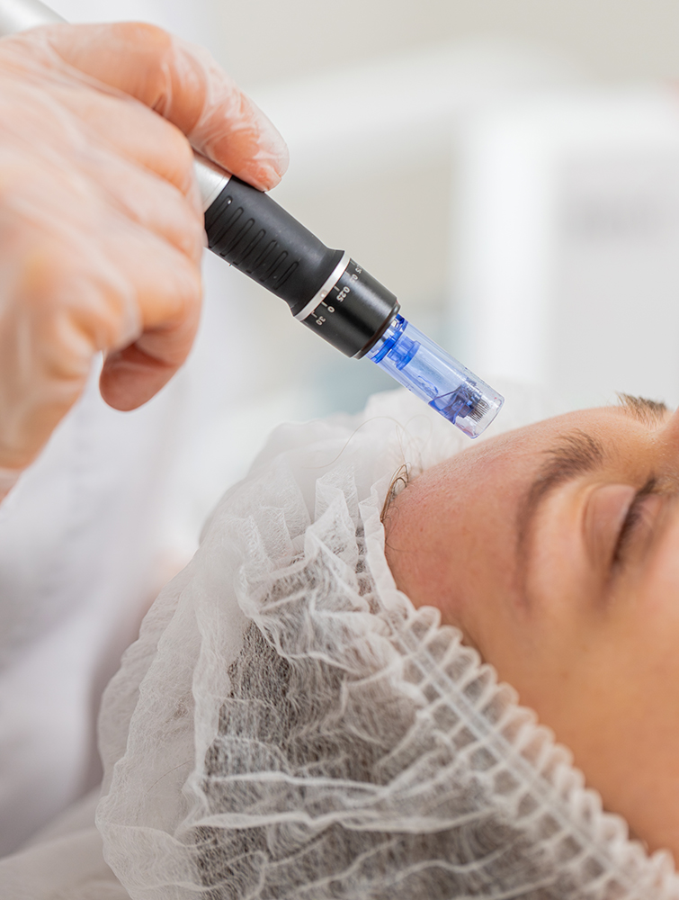 Professional microneedling skin treatment