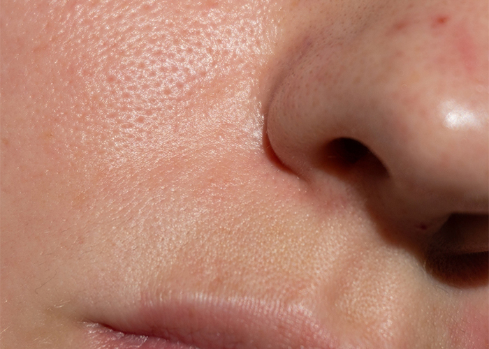 Before A Brighter, Smoother Complexion